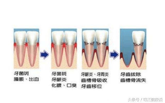 口腔护理系列：牙周脓肿，牙龈肿痛怎么办？