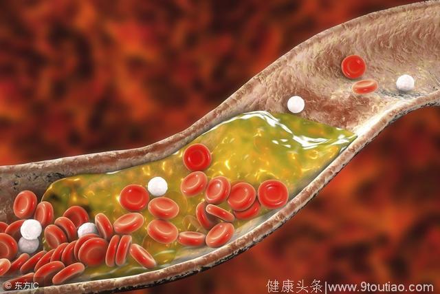 血管变”堵城“，坚持吃这两样食物，清理干净血管人长寿