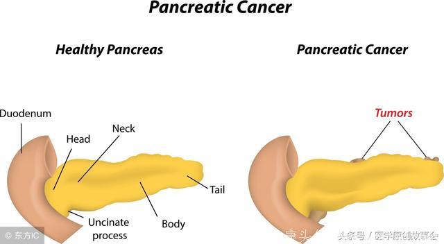 胰腺癌是癌症之王，胰腺不好会有四种标志，越早越容易忽视