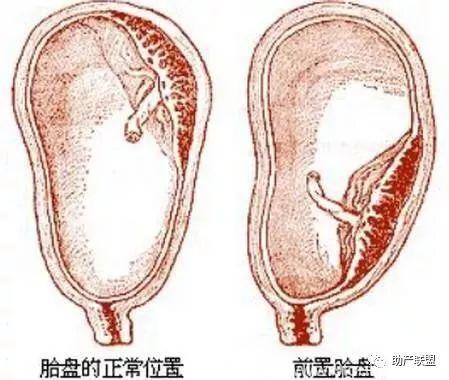 怀孕时，胎盘的前壁和后壁有什么不一样？