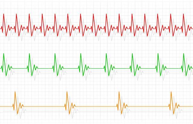 真相来了｜心律失常暗示有心脏疾病？血压正常心脏就没事？