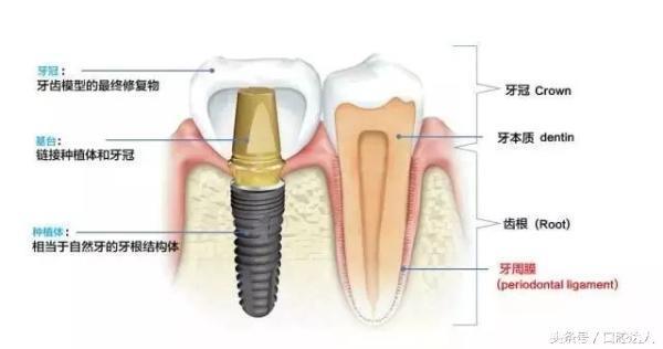 亲身经历：种植牙是可以用一辈子的