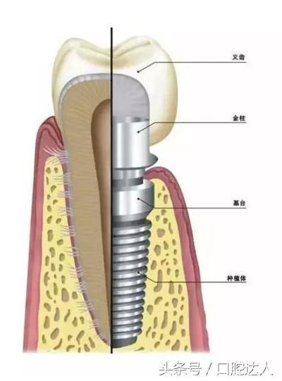 亲身经历：种植牙是可以用一辈子的
