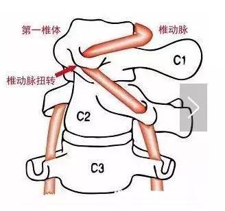 什么因素使颈椎病发生和加重？