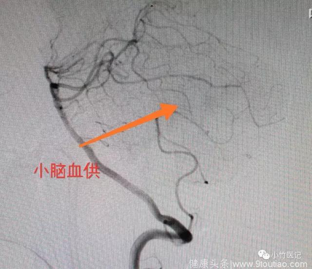 医生，我“颈椎病”，总发眩晕症！