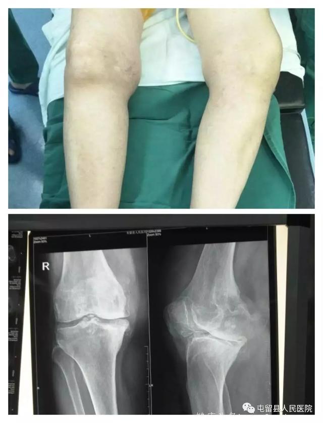 屯留县医疗集团人民医院新开展人工膝关节置换术