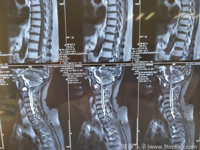 类风湿关节炎导致的严重寰枢椎脱位并颈脊髓卡压损伤四瘫手术治疗