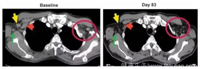 告别肿瘤成为可能！抗PD-L1强效肿瘤疫苗登陆中国