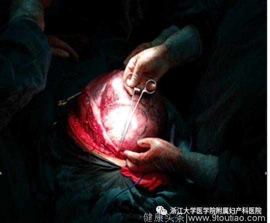小小子宫肌瘤长成“巨型炸弹”，浙大妇院专家如何“成功拆弹”？