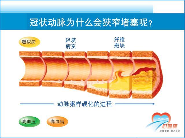 冠心病与心脏康复的这些知识你知道吗？