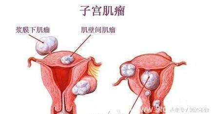 肥胖或饮食不当可加快子宫肌瘤生长