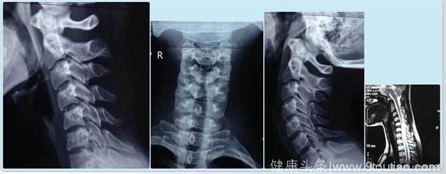 学会这三招，治疗颈椎有妙招，颈椎病头晕手麻千万别错过！