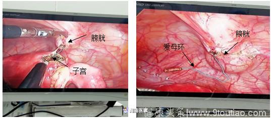 超期服役节育器隐患多多，腹腔镜微创手术来帮你忙！