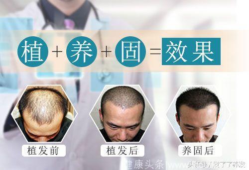 作为第一批90后脱发群体，你该先治疗脱发还是先植发？
