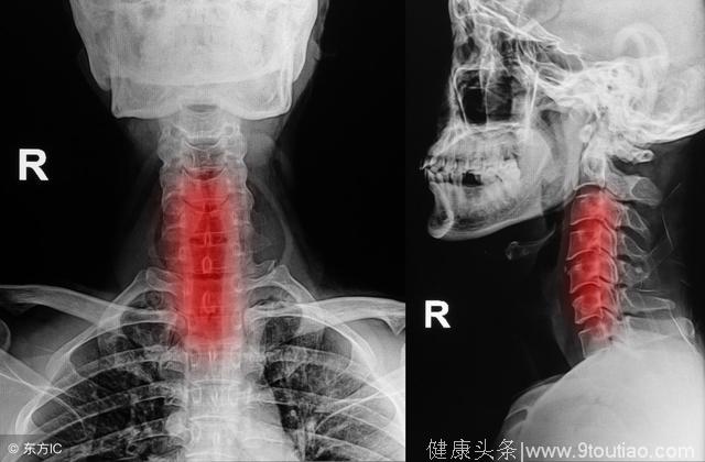 颈椎病疼痛难忍？全面了解颈椎病，对症下药，让你不在痛！