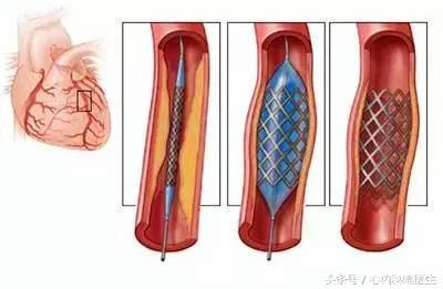 心脏病康复保养至关重要，做好医疗保健的4S店