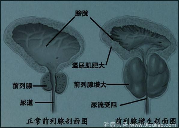 是男人，就很难逃过这一劫！这些事从现在做起，还有希望