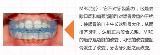 3-15岁儿童牙齿矫治新选择——MRC肌功能训练器 轻松睡出整齐牙