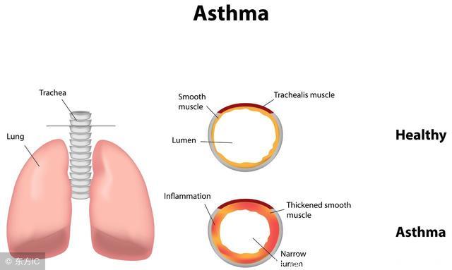 支气管哮喘有哪些比较急性的症状呢