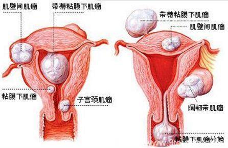 这4种食物很多女人爱吃，却可能使子宫肌瘤“长大”，尽量少吃！