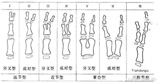 关于“六指”宝宝的那些事儿