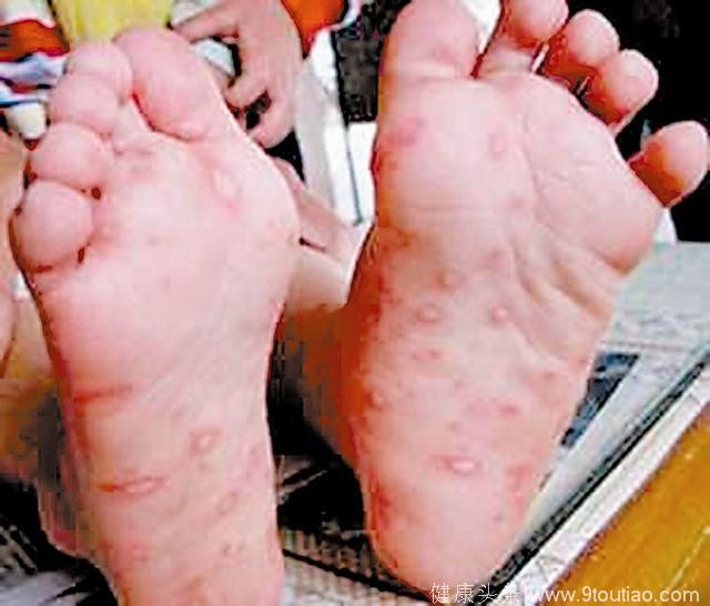 以为是普通的红疹，却被告知是手足口，最后医生说是猩红热