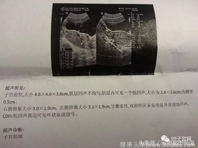 宁波女子为备孕狂吃补品，孩子没怀上，子宫肌瘤长到了26斤！