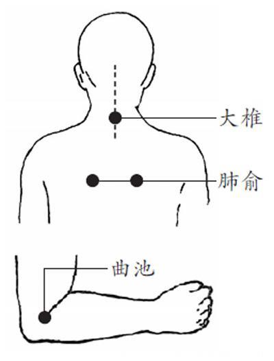 血压高不用烦恼了，3大拔罐法，“拔”走高血压！