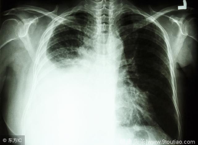 肺癌的早期五个典型症状是怎么样的呢
