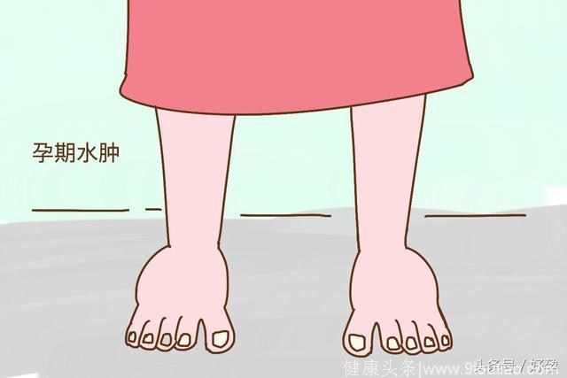 怀孕后脚水肿的厉害正常吗，有点怕，有和我一样的吗？