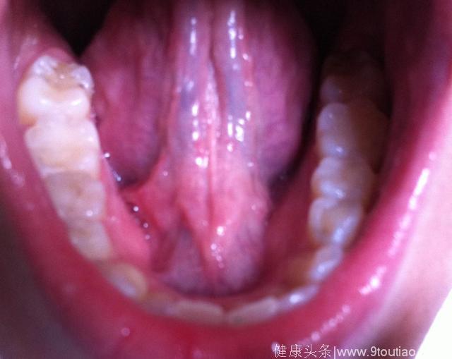 舌头上有这些表象，说明你瘀血很严重，小心心脏病