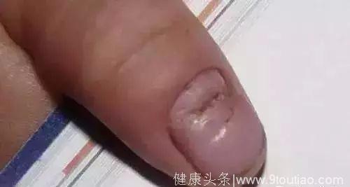 指甲长成这样，竟是癌症的信号？发生这些变化