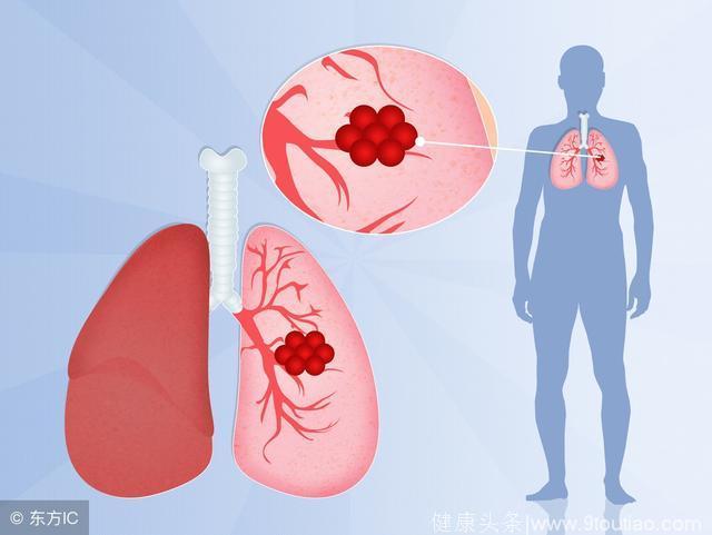 肺癌是一种“狡猾”的癌症，注意六小症状暗示肺癌