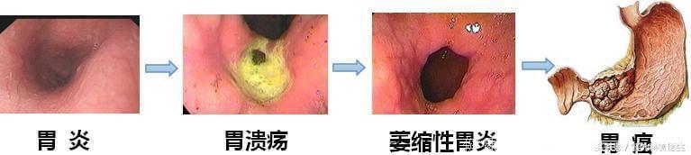 专家提醒，4种疾病容易发展为癌症，快来看看你有没有中招？