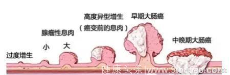 专家提醒，4种疾病容易发展为癌症，快来看看你有没有中招？