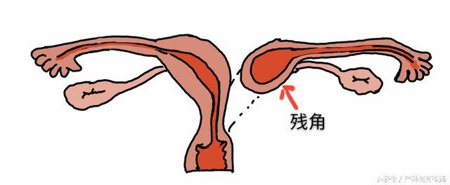 异位妊娠之残角子宫妊娠