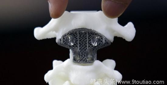 澳医生用3D打印脊椎 成功帮一名患病儿童找回自己