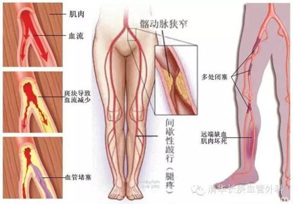 糖尿病常引发这4类并发症，遵循这2大原则，能有效预防并发症