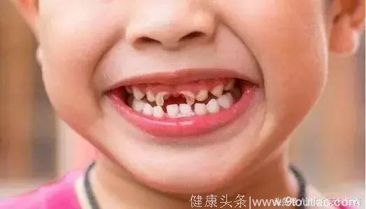 儿童换牙齿换几颗？乳牙出得晚耽误换牙吗？
