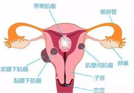 由里→外,可把子宫肌瘤分为这3类:按照肌瘤与子宫肌壁的关系部位分类