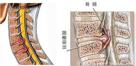 脊髓型颈椎病早发现，警惕颈椎常见的3个症状