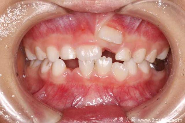 10个孩子里面5个长双排牙，杭州口腔医生感叹：都是家长害的！