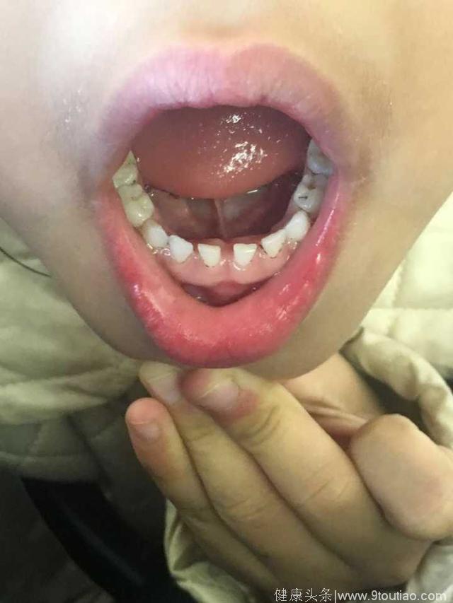 10个孩子里面5个长双排牙，杭州口腔医生感叹：都是家长害的！