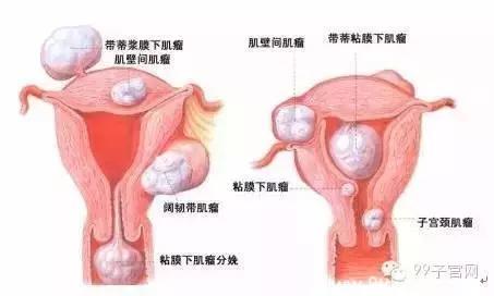 医生患有子宫肌瘤，是如何治疗的？