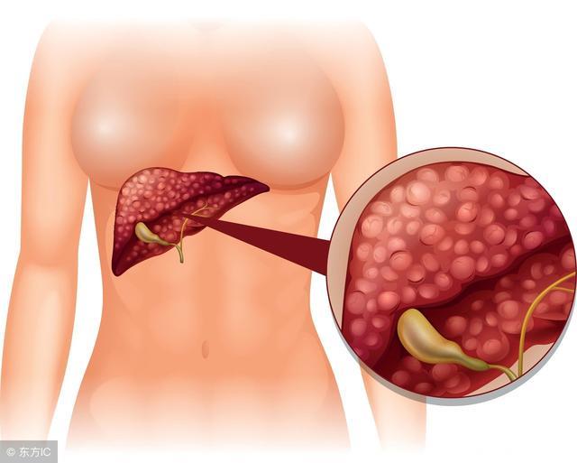 肝内钙化灶的发生，或与这3个因素有关，都不是好惹的