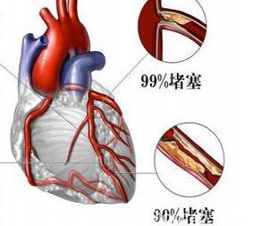 心脏血管狭窄多少算是冠心病？告诉你真相！