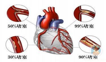 心脏血管狭窄多少算是冠心病？告诉你真相！