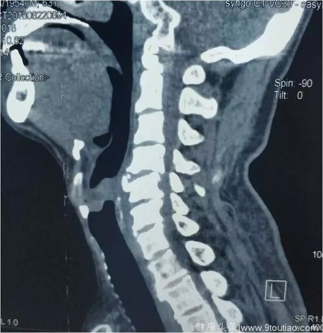 颈椎管狭窄——前路还是后路？
