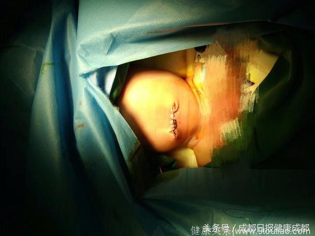 胎宝宝患腹裂畸形 肠子掉在母亲子宫内 医生巧施妙手救回母子俩