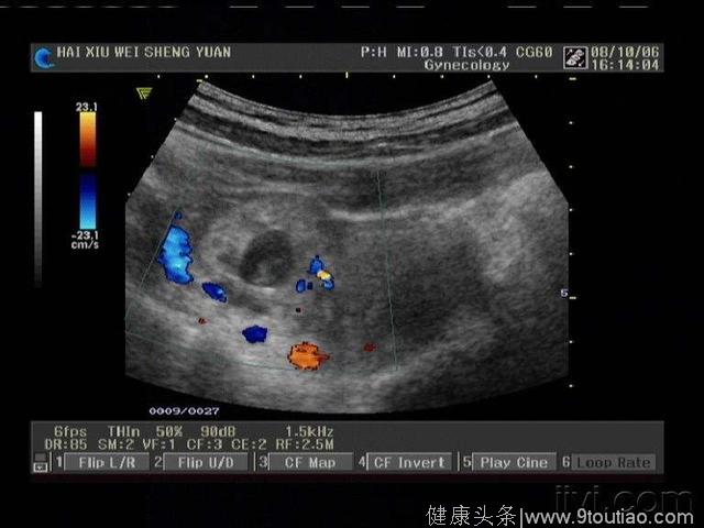 医院说五千元人工授精保怀孕，女子花7万结果宫外孕：被忽悠了？